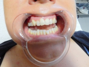tand bleek voor (Medium)
