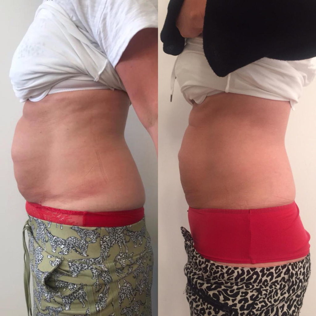 Cryolipolyse behandeling bij Blush Clinic Groningen