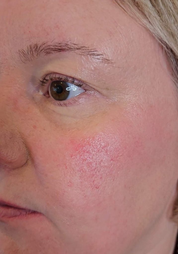 Rosacea en minerale make-up: een perfecte match en een Demo
